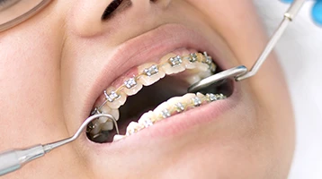 Boca com aparelho ortodôntico fixo tradicional