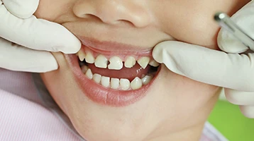 Dente infantil precisando de restauração